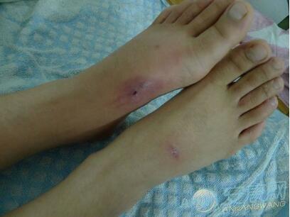   我梦见自己被蛇咬了