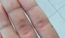 你现在是不是手很疼