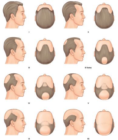 关于秃头的寓言词