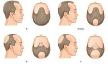 有关秃子的头发的歇后语